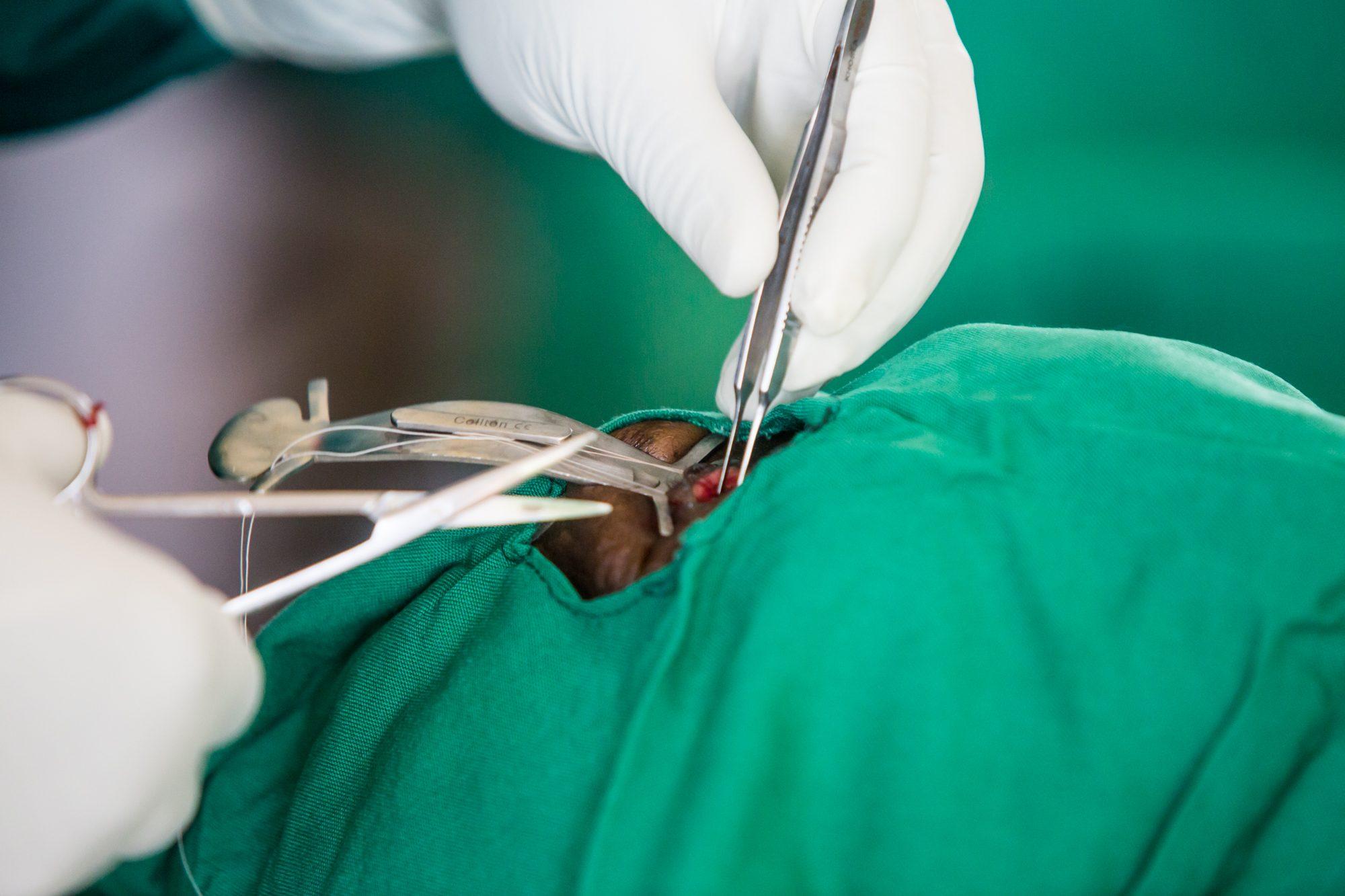Trichiasis Surgery — photograph 5